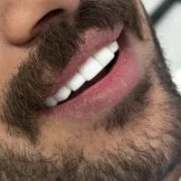 کامپوزیت/روکش/عصبکشی/ایمپلنت/لمینت