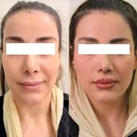 تزریق ژل و مزوژل یا لیفت نخ - تخفیف ویژه و اقساط