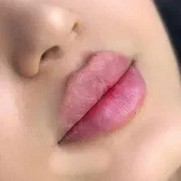 تزریق ژل وبوتاکس