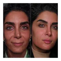 آموزش خدمات بوتاکس فیلر شیراز، کوشک میدان