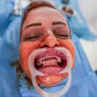 کاشت دیجیتالی ایمپلنت (قیمت ۳۸ تومن )