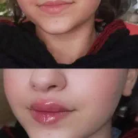 تزریق فیلر،بوتاکس،آنزیم،پیرسینگ
