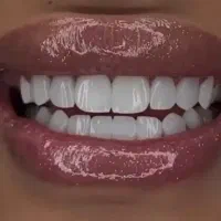 دندان مصنوعی شهر محلات تحویل۵ساعته کامپوزیت دندان