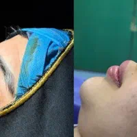 ۳۳میلیون رینو(جراحی بینی )
