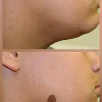 برداشتن خال و زیگیل تضمینی(ماه‌گرفتگی)