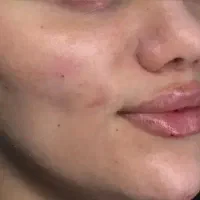 ژل وفیلر و بوتاکس با کمترین قیمت درشهرستان