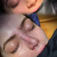 فرصت عالی رینوپلاستی