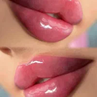 دایرکت و لیفت ابرو /شقیقه/زاویه سازی/ژل لب/بوتاکس