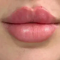 تزریق فرمدهی لب گونه چانه زاویه سازی و کانتورینگ