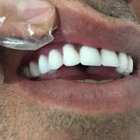 طرح کامپوزیتی تحویل ۱ روزه