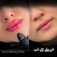 لیپوساکشن/کاشت مو/ بلفاروپلاستی/اقساط بدون کارمزد