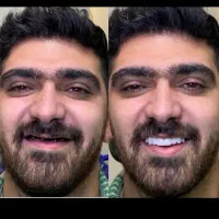 ایمپلنت کره ای واحدی 10/900