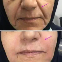 راهنمایی جوانسازی پوست و رفع چین و چروک بدون تزریق