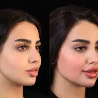 جشنواره عید تاعید ژل بوتاکس مزو (حتی روزای تعطیل)