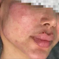 تزریق ژل و بوتاکس آرایش دایم تتو فیشال