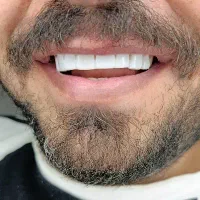 (دندانپزشکی)کامپوزیت با تخفیف ویژه