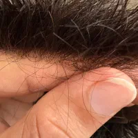 پروتز مو وارداتی