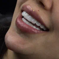 کامپوزیت ولمینت،ایمپلنت بدون پیش پرداخت