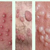 رفع قطعی و دائمی زگیل و‌تبخال