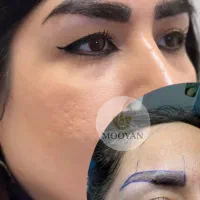 کاشت مو ۲۲ و کاشت ابرو ۱۵