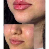 به مدل فیلر لب ، چونه ،گونه  زاویه سازی 500 تا 700