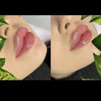 مدل فیلر ، بوتاکس ، مزو ژل