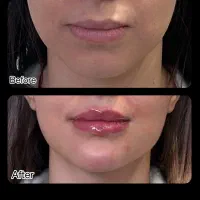ژل وبوتاکس ومزوژل ولیفت نخ وپی ارپی
