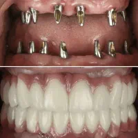 دندان مصنوعی پروتز کامل 18میلیون زیبایی دندان پزشک