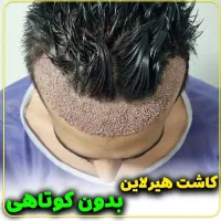 کاشت مو و ابرو میکرو کاشت (رایگان)