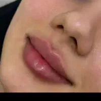 مدل جهت ژل و بوتاکس