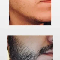 ریش کم‌پشت راهکارش اینجاست