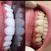 جشنواره کامپوزیت دندان فکی۲۰م تومانvipدرمحل زیباجو