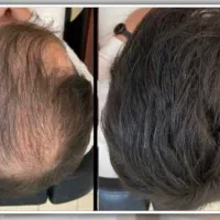 افزایش تراکم موی سر