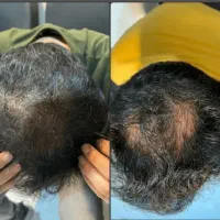 نمایندگی اصلی فروش محصولات ضد ریزش