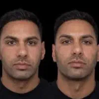 ریش آقایان فیلر خانمها مدلینگ هالیوودی پزشک L PRP