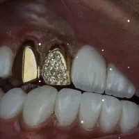 دندان طرح طلا و طرح نقره