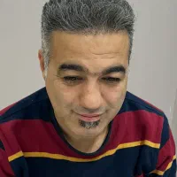 کاشت مو طبیعی در رشت