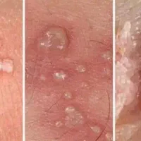 جلوگیری از سرطانی شدن زگیل