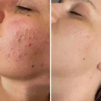 پاکسازی صورت