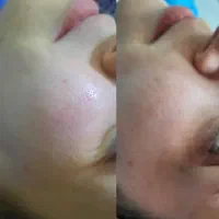 فیشال و پاکسازی تخصصی پوست