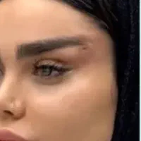 لیفت با نخ کاگ ۲/۸۰۰ ،لیفت فرم دهی بینی با نخ و ژل