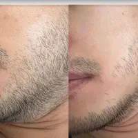 رویش ریش وسبیل در ۳۰روز تضمینی