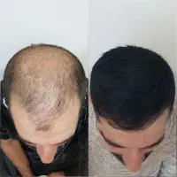 دیگه کچل نباش