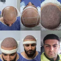 جشنواره عید کاشت مو ۹ میلیون باضمانت vip فول تراکم