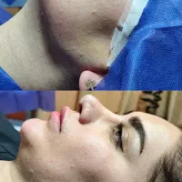 لیپوساکشن ،بلفاروپلاستی، بوکال فت، لیفت صورت