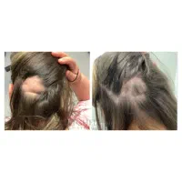 کابوس ریزش سکه ای رو از بین ببر