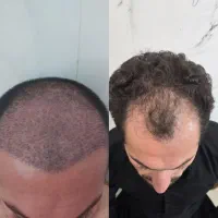 کاشت مو و ابرو میکرو کاشت (رایگان)|خدمات زیبایی و سلامت|تهران, مرزداران|دیوار
