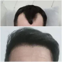 نگران کم پشتی موهات نباش