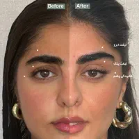زیبایی طبیعی بدون درد/با تخصص برتر/دکتر مجرب