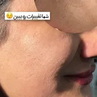 فیشیال پاکسازی و درمان تضمینی پوست|خدمات آرایشگری و زیبایی|کرمانشاه, |دیوار